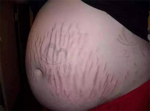 妊娠纹示意图