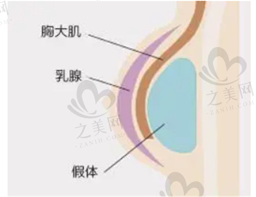 厦门海峡医疗美容隆胸技术靠谱