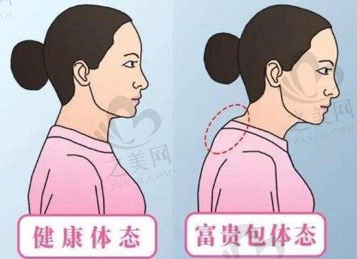 深圳曹孟君治疗富贵包价格不到九千，是由土麦森吸脂术来有效解决