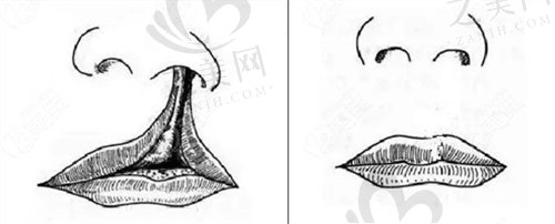 唇裂修复术后对比图