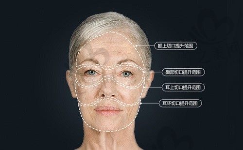 何奇面部提升术仅需四万多，利用南雅特色微拉美技术术后免拆线