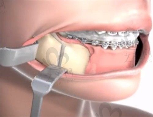 重庆松山医院正颌怎么样看王涛,柔性正颌改善凸嘴歪脸8W起！