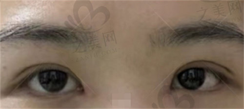 韩国EVE整形内眼角修复评价1.jpg