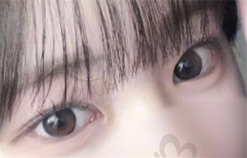 韩国EVE双眼皮整形评价2.jpg