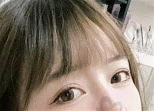 韩国博朗温整形外科双眼皮评价2.jpg