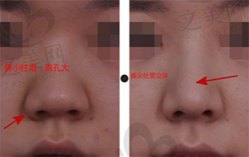 韩国韩娜鼻整形医院 自体软骨隆鼻