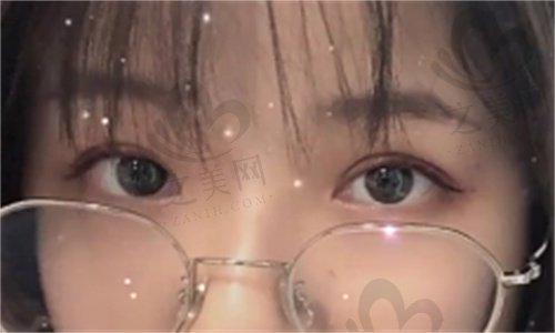 韩国BBC整形外科双眼皮修复评价2.jpg