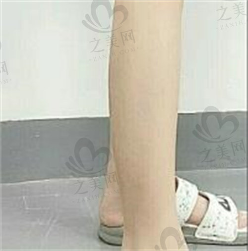 韩国Bonclinic整形外科小腿吸脂评价.jpg