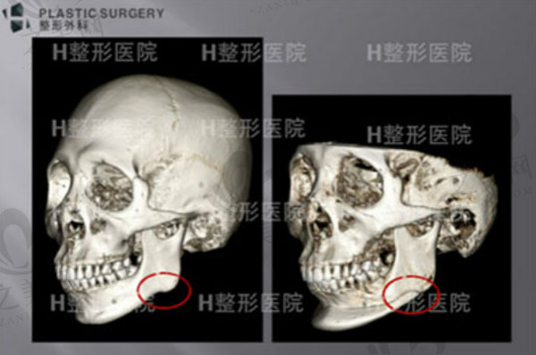 韩国H白汀恒整形外科3D Fit技术