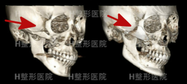 韩国H白汀恒整形外科头颅CT