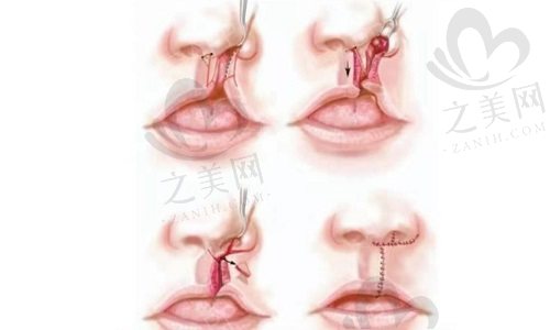 唇腭裂整形过程示意图