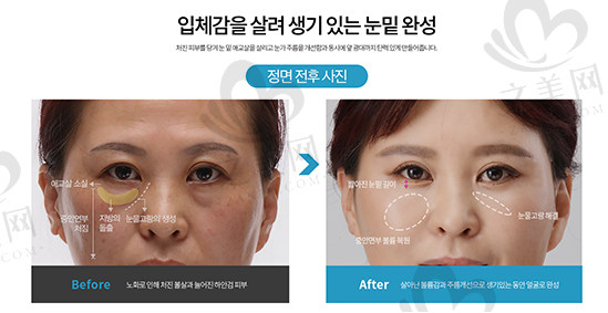 韩国大眼睛整形医院 眼底脂肪重列