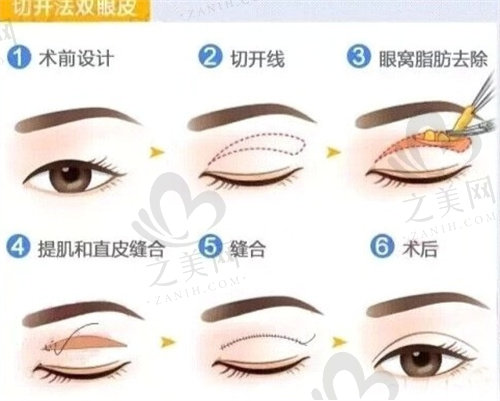 上海华山医院整形外科双眼皮过程
