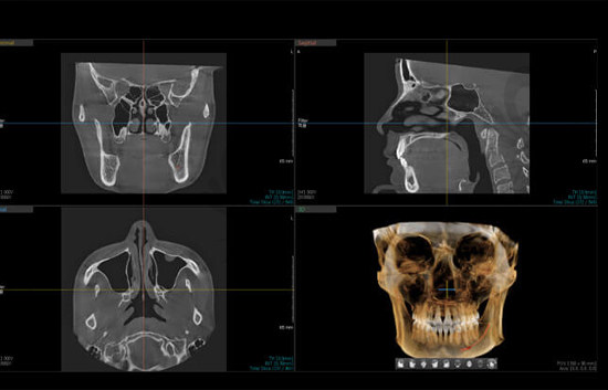 优雅人 鼻修复3D-CT立体分析