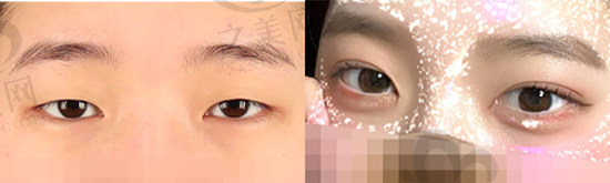 韩国TS 眼睑整形