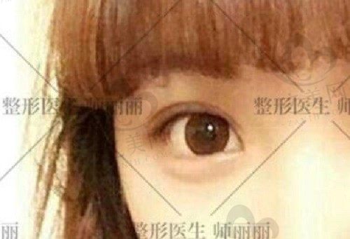 师丽丽双眼皮修复价格2w出头，内眼角修复术后自然隐痕很是惊艳
