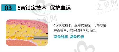 SW乳化吸脂锁定技术