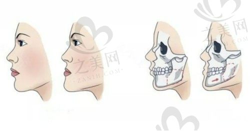 广州广大医院正颌手术技术好且价格不贵，3D导板正颌技术仅5W元起