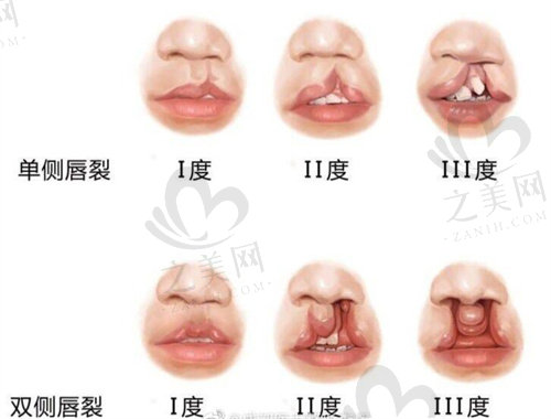 上海新华医院整形外科唇裂程度