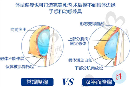 上海新华医院整形外科双平面隆胸
