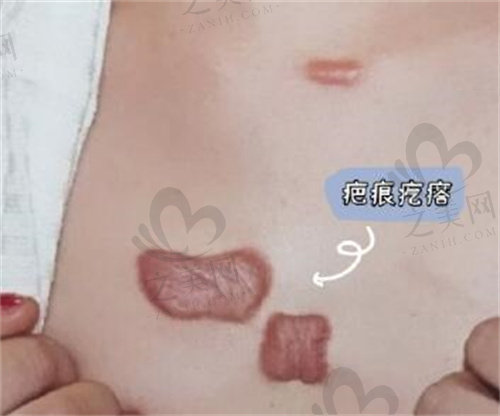上海华东医院整形外科疤痕疙瘩