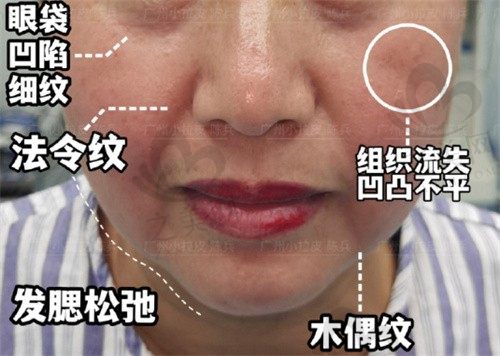 南方医科大学珠江医院整形科陈兵做拉皮好,且附上费用详情!