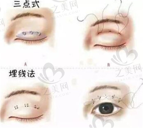 中山大学附属第二医院整形科双眼皮