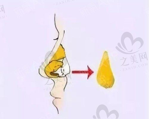 隆鼻手术 隆鼻手术