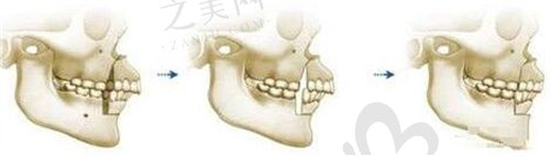 深圳市安人民医院整形外科正颌