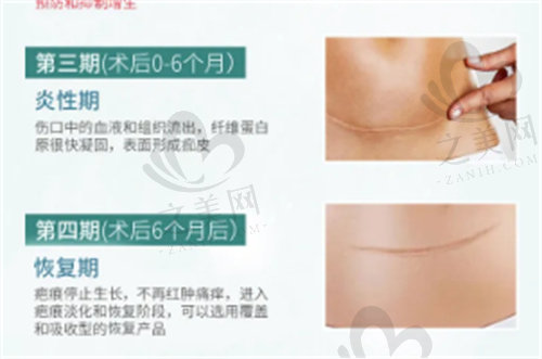 深圳蛇口人民医院整形外科疤痕恢复周期