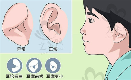 四川大学华西医院做外耳再造的方法