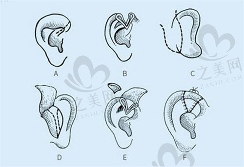 四川大学华西医院做耳再造