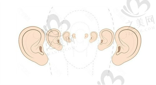 扩张法耳再造的流程