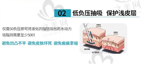 深圳大学总医院美容科负压吸脂
