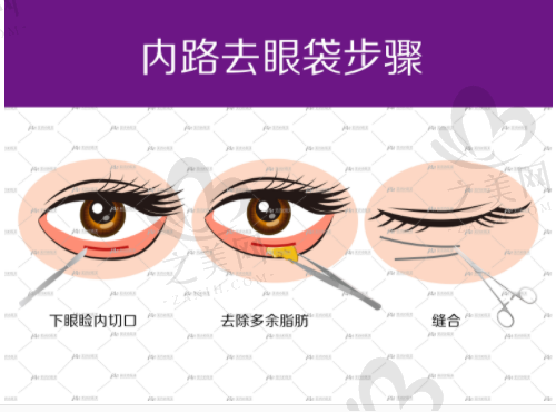 北京协和医院美容科超声法去眼袋的价格