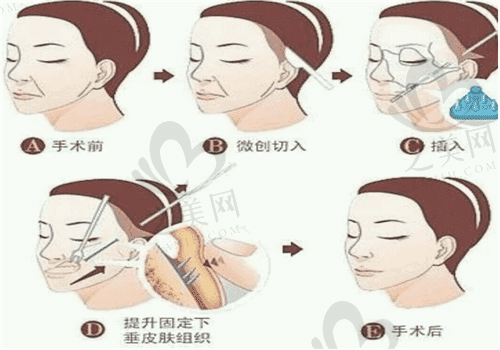  广州军区总医院整形科拉皮手术过程图