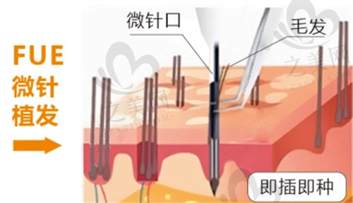 FUE微针植发演示