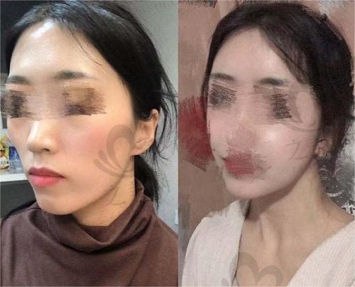 韩国脸本整形外科真人图