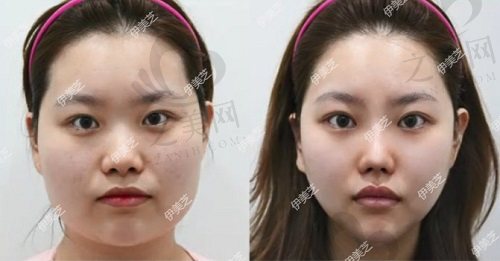 韩国伊美芝整形外科手术实例1