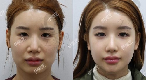韩国伊美芝整形外科手术实例2