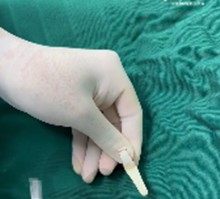 刘波医生做鼻子怎么样?附上刘波医生做鼻综合案例和价格