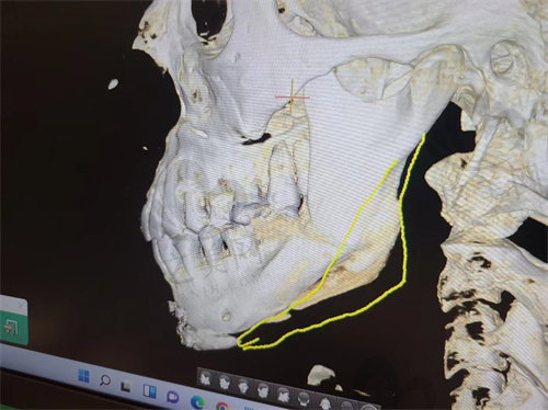 韩国欧佩拉整形外科下颌角补骨