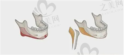 上海长征医院整形科磨骨怎么样