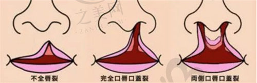 上海长征医院整形科唇腭裂修复多少钱