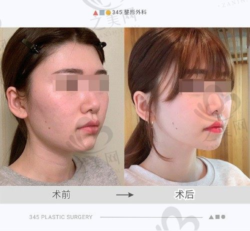韩国345整形医院怎么样?院长朴钟林做轮廓双鄂技术好