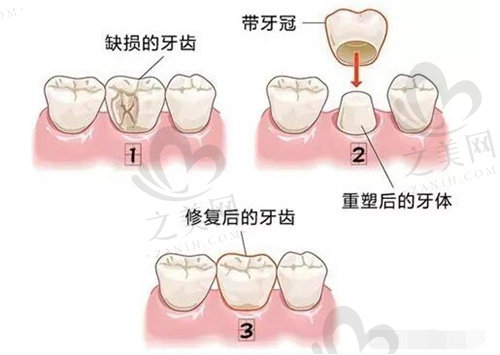 全瓷牙过程