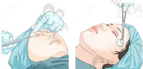 成都艺星医疗美容医院怎么样?正规可靠吗?附隆鼻案例