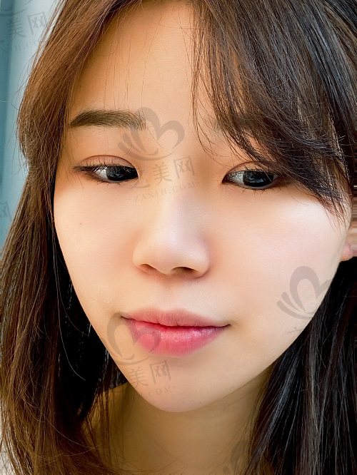 在韩国优雅人整形外科做肋骨鼻修复前