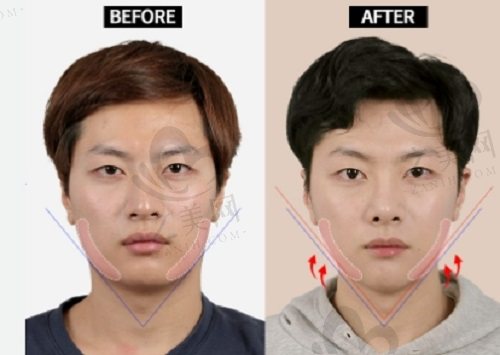 韩国ID整形外科真人实例