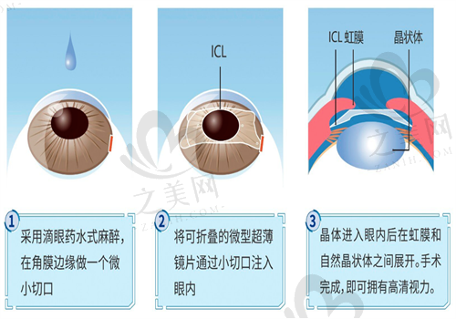 浙大医学院附属第二医院眼科手术图